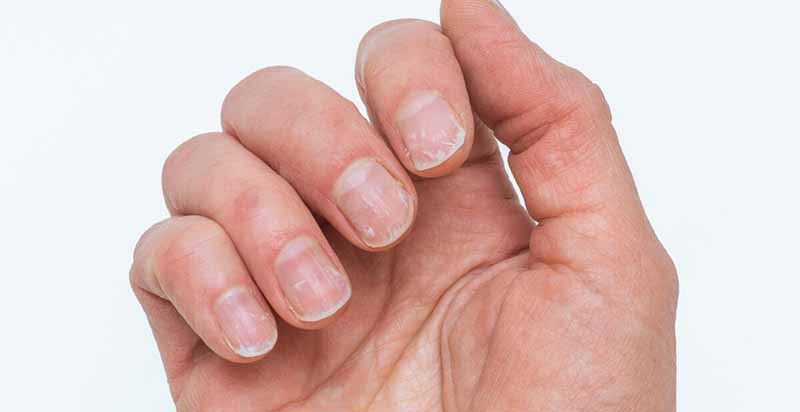 The Complete Guide to Brittle Nails: Causes, Solutions, and Prevention